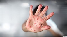 Минздрав назвал причину вспышки кори в Самаркандской области