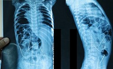 В Узбекистане ребенок, в теле которого найдены иголки, вернулся домой